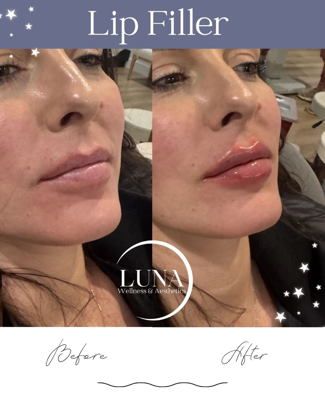 POV: You finally found the lip injectors everyone&rsquo;s been talking about 💋✨

These gorgeous, natural-looking lips were thoughtfully customized to enhance shape, balance, and volume while still looking beautifully YOU. The perfect pout is all abo