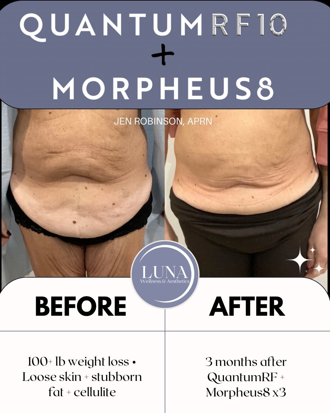 These before and afters mean so much to me because they represent something bigger than aesthetics&mdash;they represent meeting patients where they are.

This beautiful patient had already accomplished something incredible: losing over 100 pounds aft