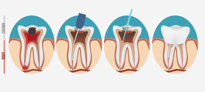The Effectiveness of Various Root Canal Irrigants on Necrotic Root Canal Bacteria