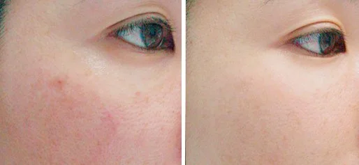 LASER SKIN TREATMENTS