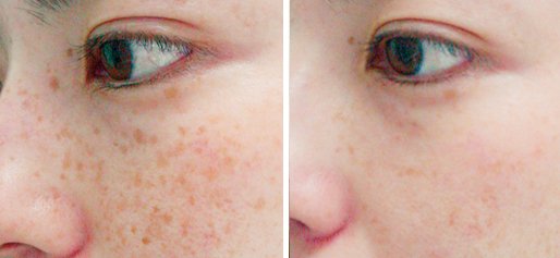 LASER SKIN TREATMENTS