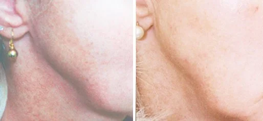 LASER SKIN TREATMENTS