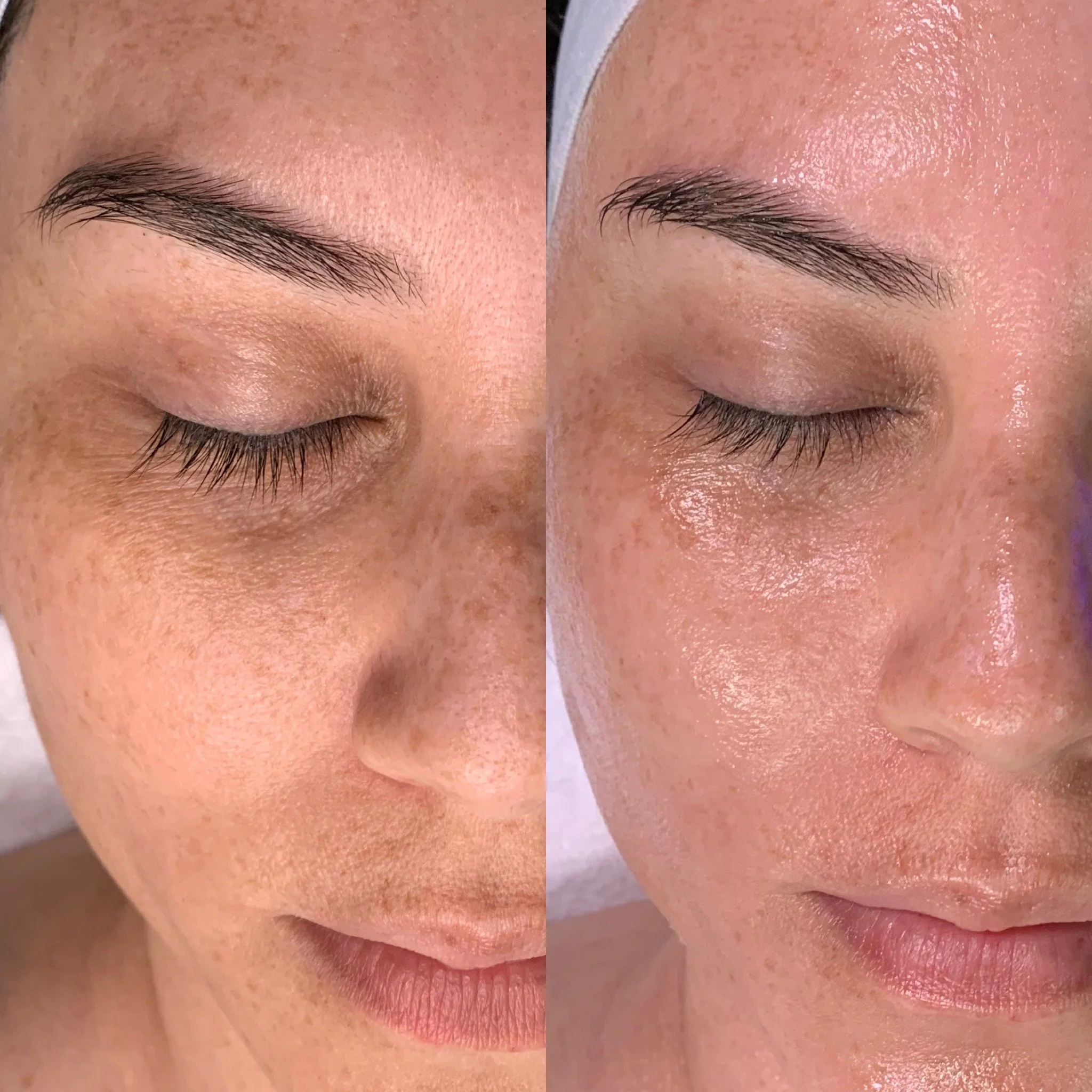 hydrafacial burnaby bc