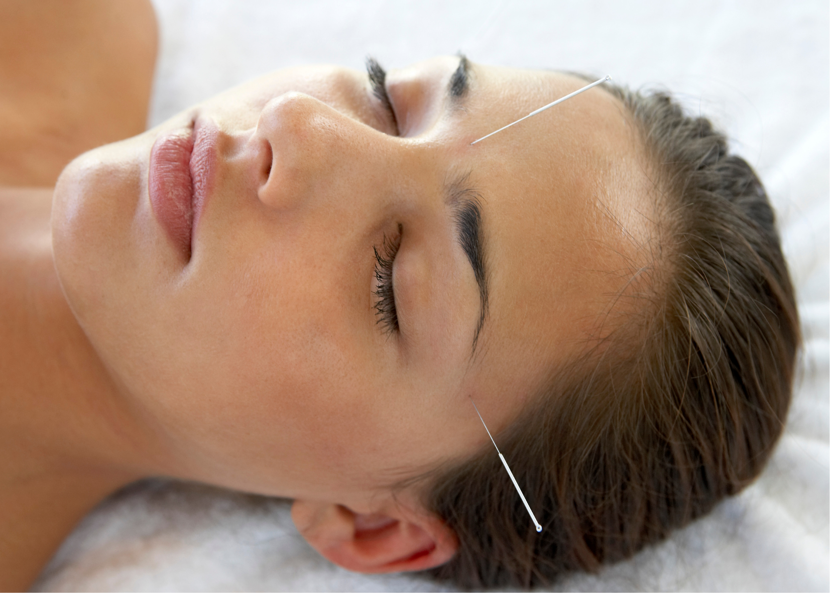 Facial Acupuncture and the Long Game: An Approach to Aging Well