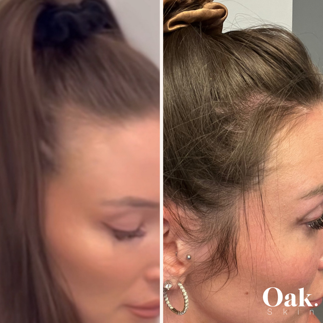 hair regrowth treatment