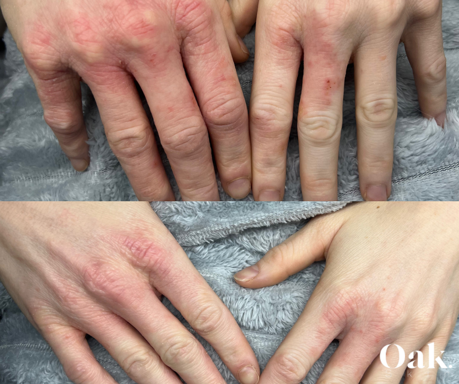 psoriasis treatment