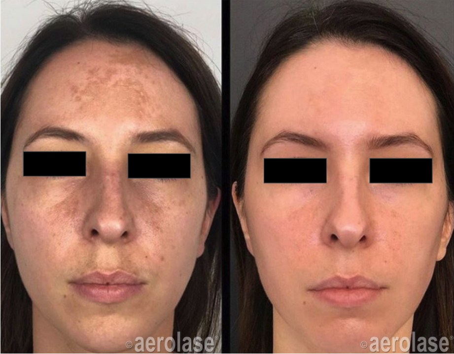 laser for hyperpigmentation
