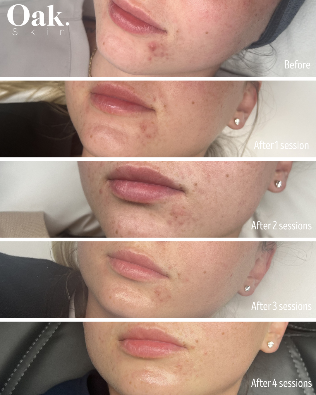 Acne treatments in burnaby