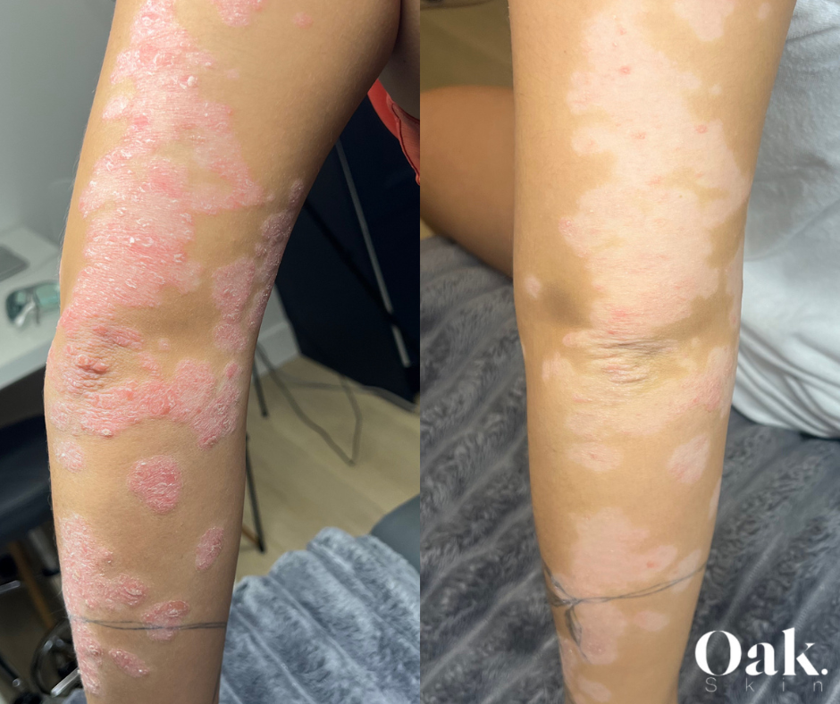 Eczema treatments in Burnaby