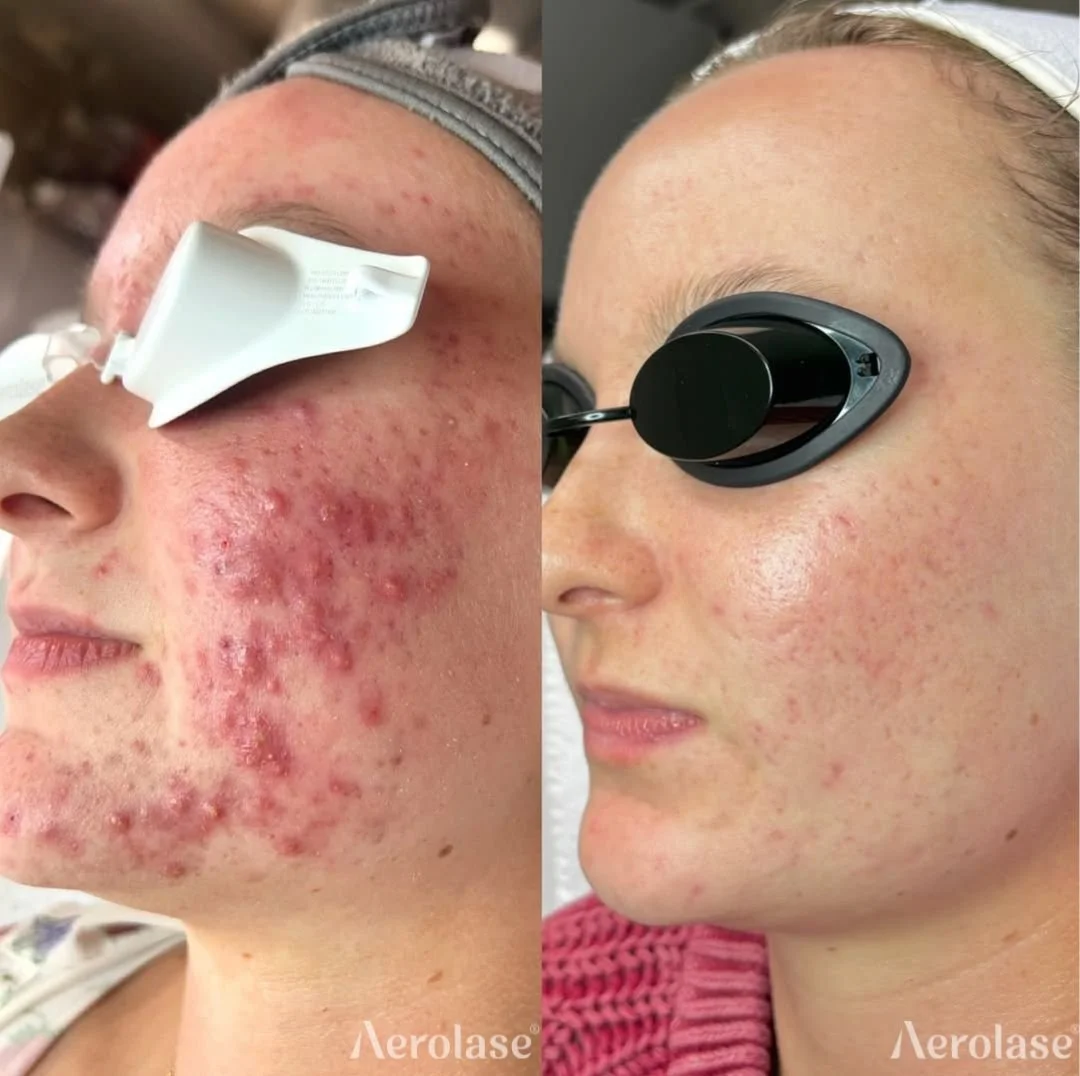 Acne Treatments in Burnaby, BC
