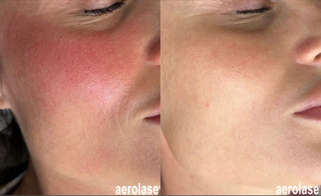 best products for rosacea