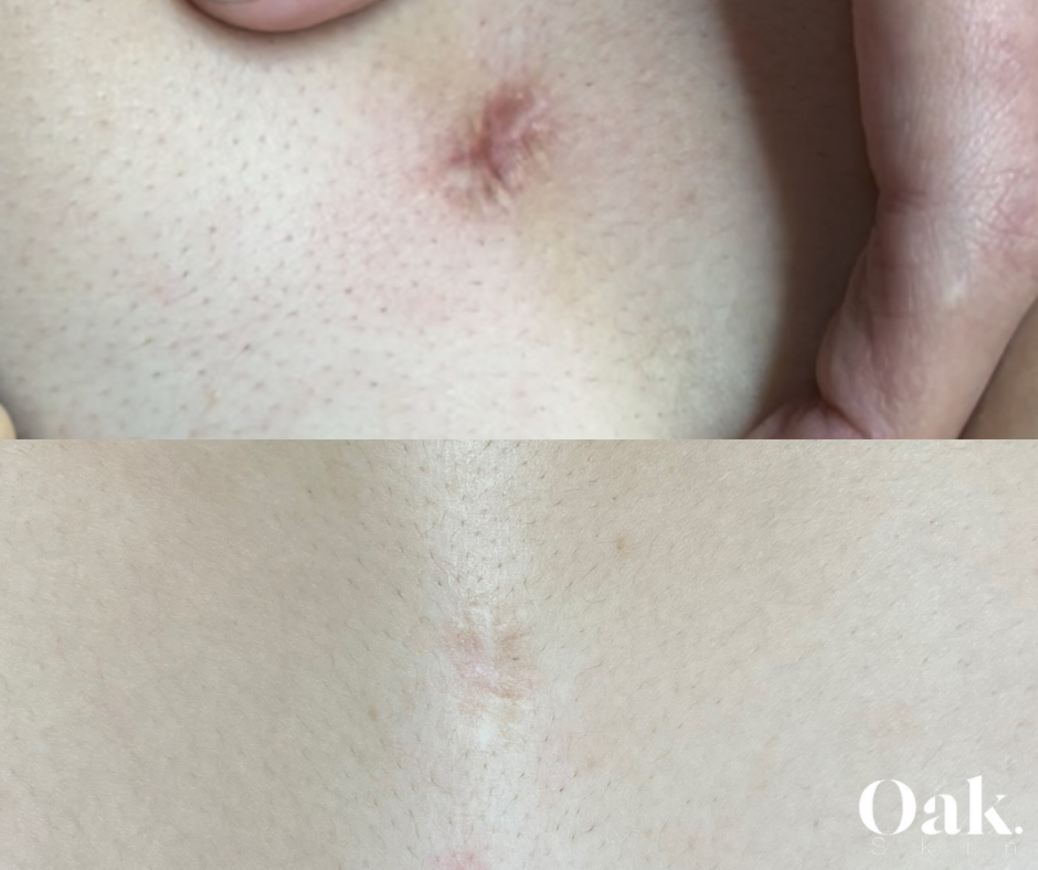 microneedling with PRP for scars
