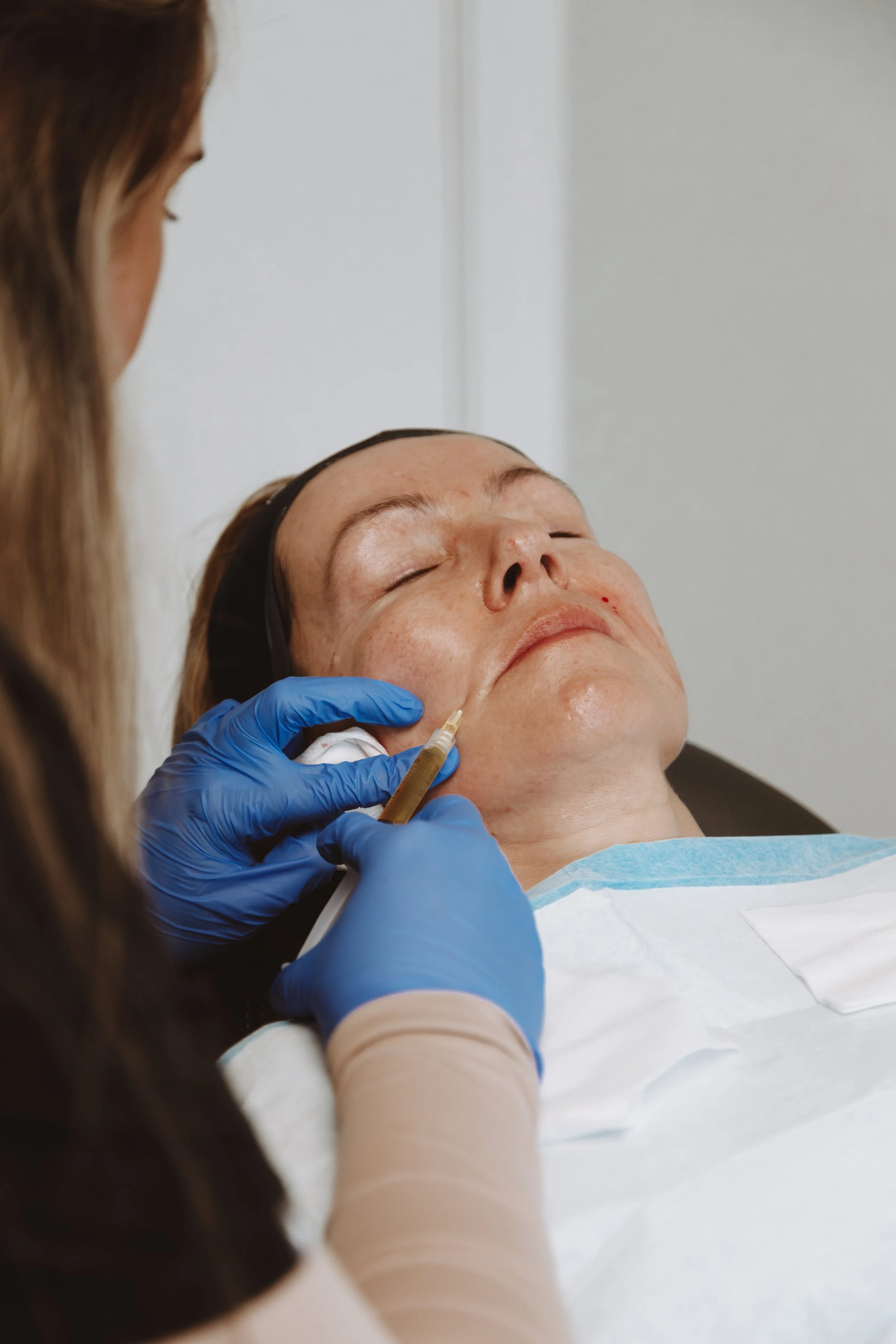 vampire facial treatment