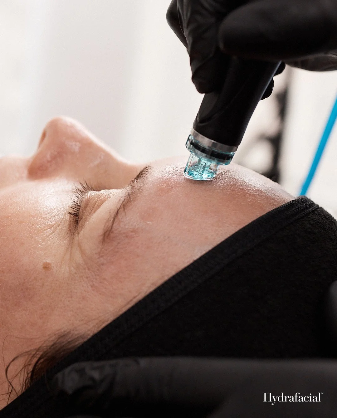 hydrafacial near me burnaby