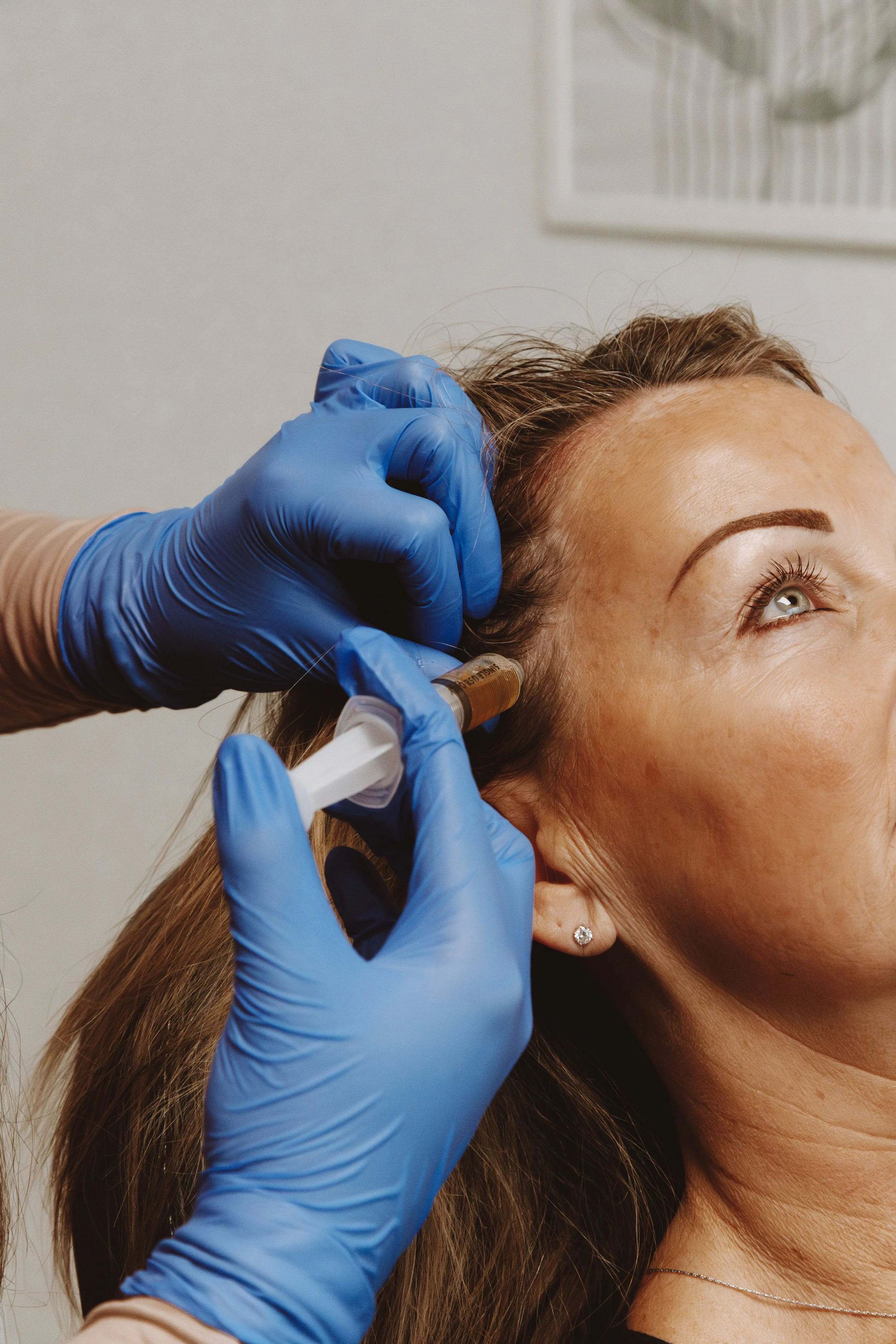 prp scalp treatment burnaby