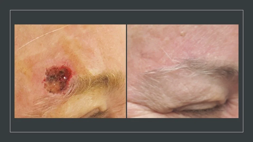 San Francisco Mohs Surgery Clinic | CCDS