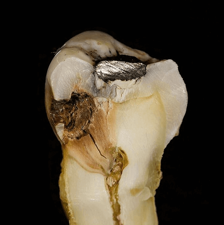 010818035058DentalDecayToothCaries.png