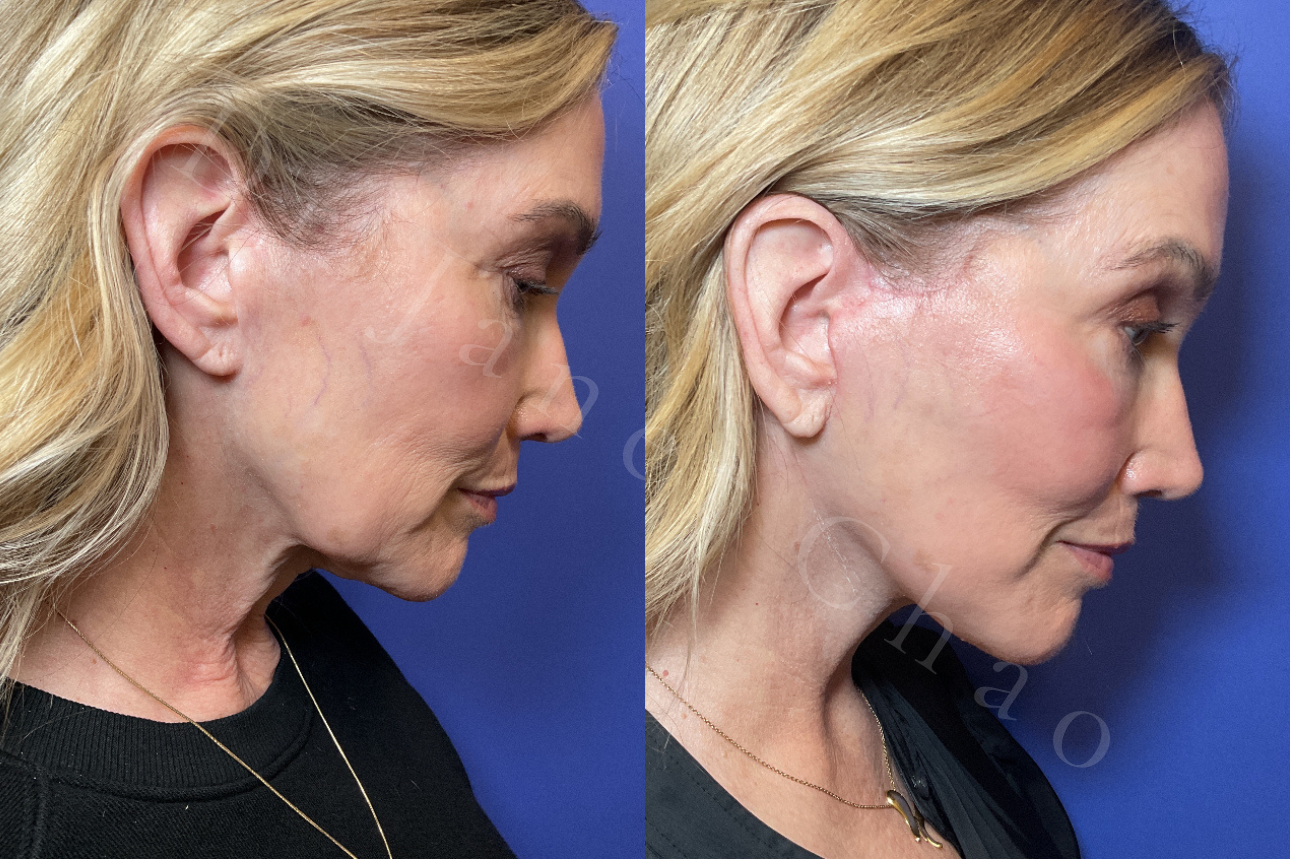 Revision Deep Plane Facelift Necklift before after 3 | Timeless Faces.png