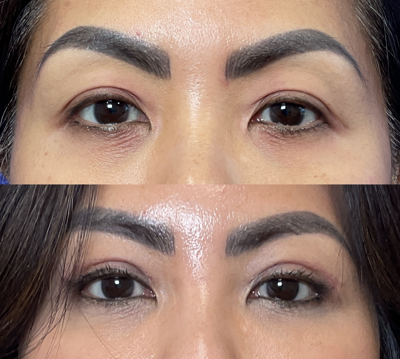 Patient results 1 month after Upper Eyelid Surgery at Timeless Faces