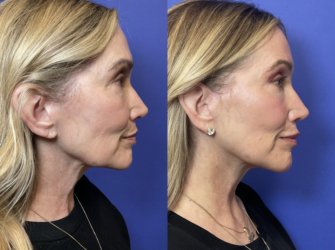 Before and after photos following Revision Deep Plane Facelift and Necklift surgery at Timeless Faces