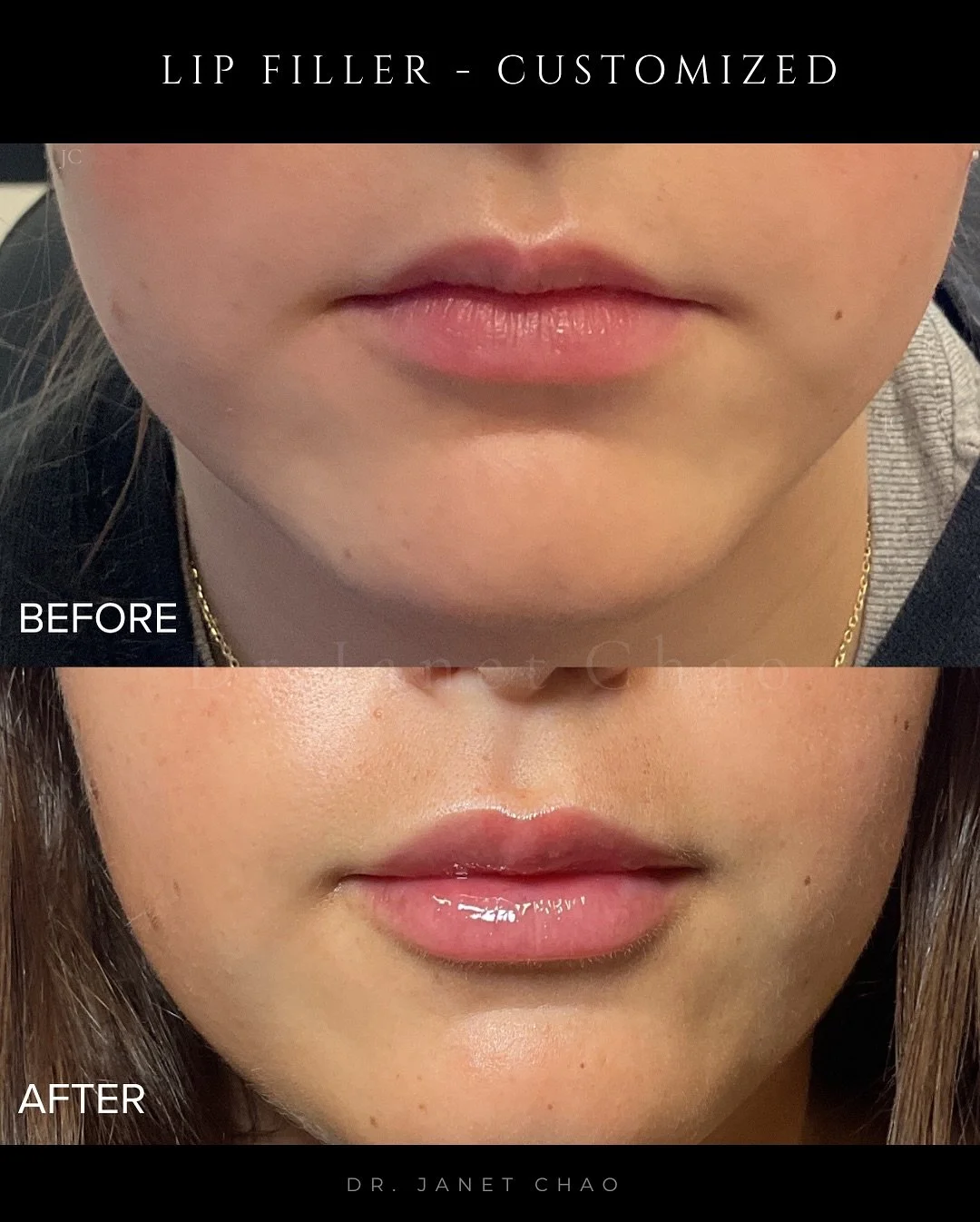 Not everyone wants the same lips, and they shouldn&rsquo;t. Some patients want volume. Others want subtle definition. My approach is always customized: the type of filler, the amount, and the placement are designed specifically for YOUR lip shape, pr