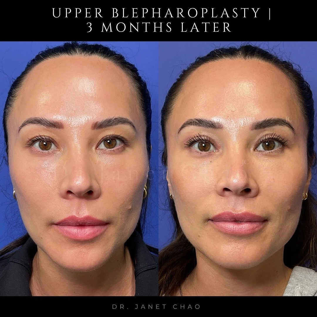 3 months after eyelid surgery, healing beautifully.
At this stage, the eyes look more open and refreshed while still completely natural.

This procedure, known as upper blepharoplasty, is performed under local anesthesia in the office.
Most patients 