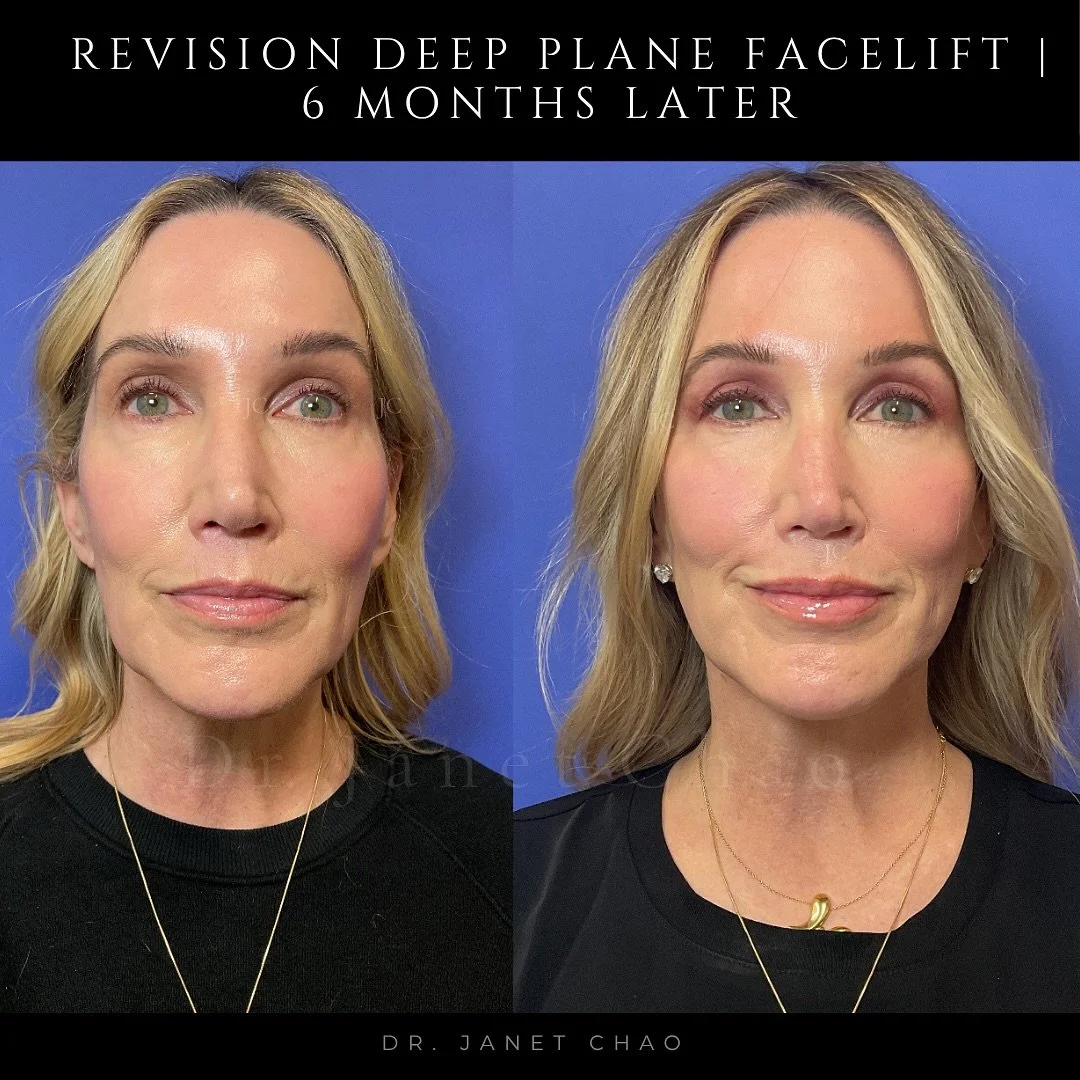 ✨ Revision Deep Plane Facelift in 60 year-old patient| 6 Months Pre and Post-Op

One of the biggest fears I hear is:
👉 &ldquo;Will I look pulled?&rdquo;
👉 &ldquo;Will I still look like myself?&rdquo;

This deep plane facelift shows that surgery sho