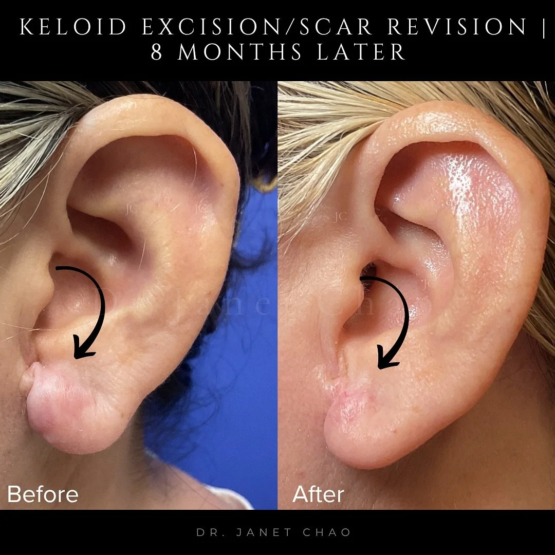 Keloids are overgrowths of scar tissue that can form after trauma or surgery, especially in patients who are genetically prone to them. This patient previously had a neck lift and earlobe reduction elsewhere and developed painful, itchy keloid scars 