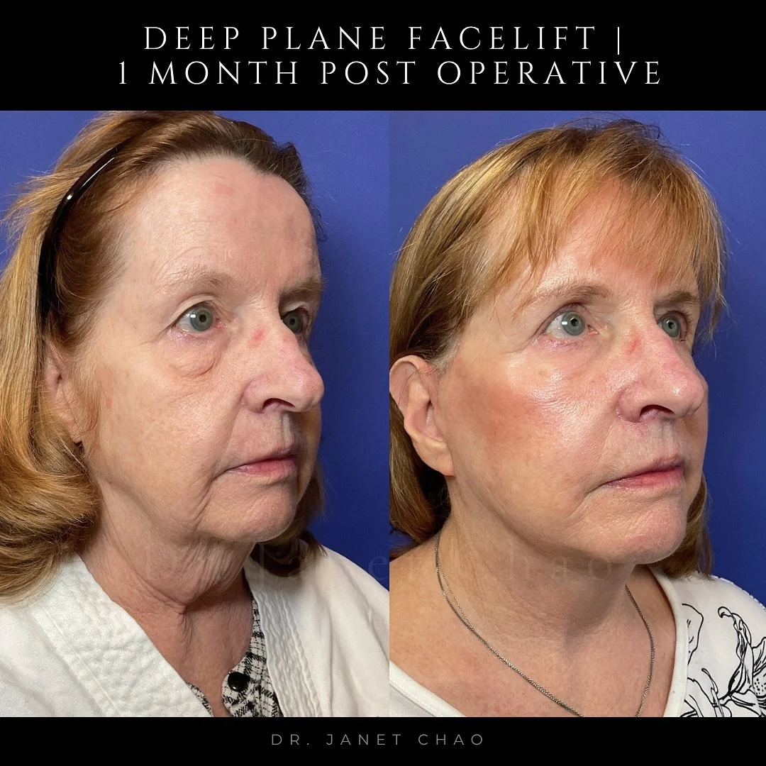 One month after her deep plane facelift, this 70-year-old patient radiates confidence and joy.
Her transformation looks natural yet powerful, lifting not only her features but also her spirit.

Age beautifully. Live confidently.

#DeepPlaneFacelift #