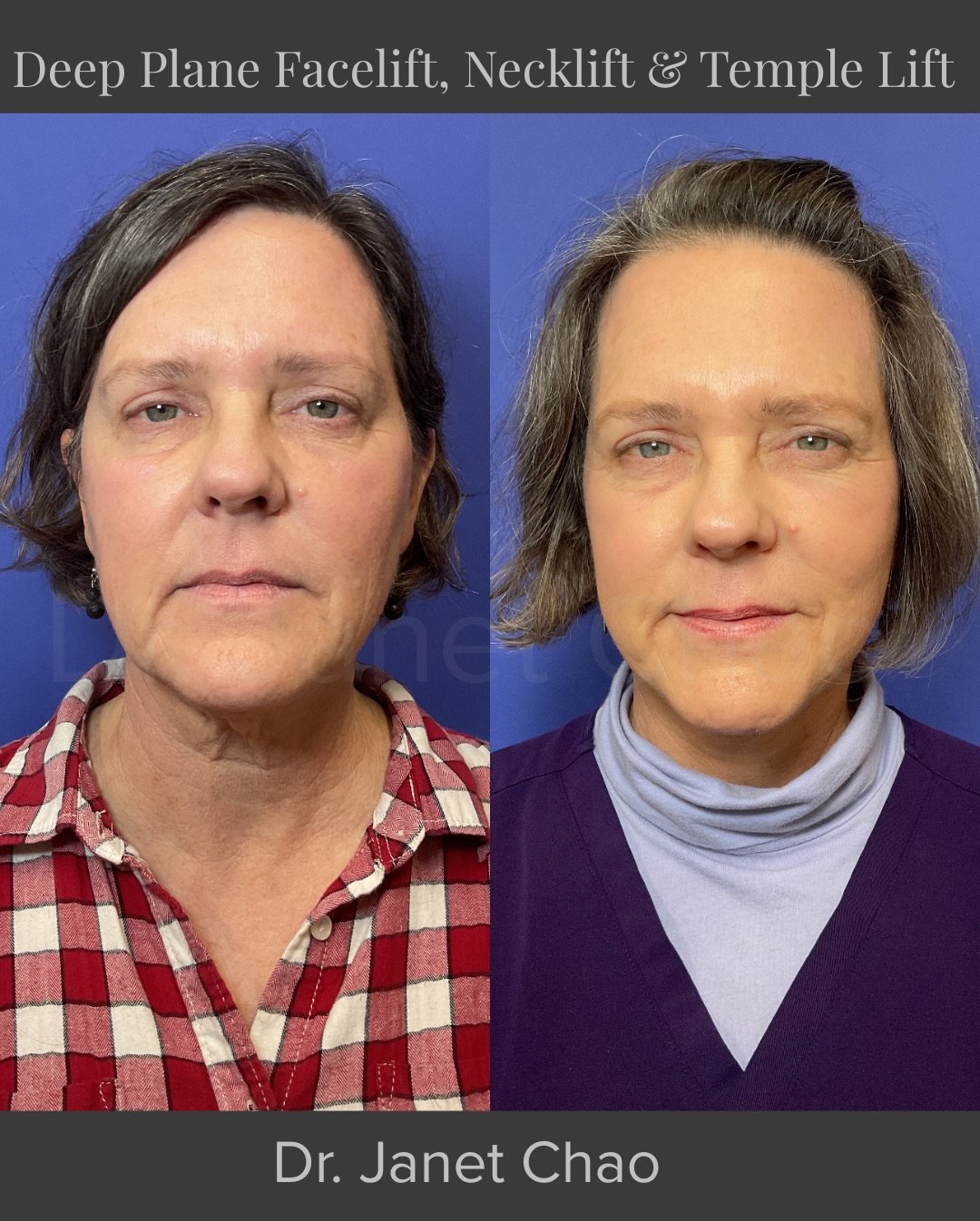 Five weeks post deep plane facelift, neck lift, and temple lift. Healing beautifully and already back to work. A friend told her they loved her haircut which is always my favorite compliment. Natural facial rejuvenation should refine your features wi