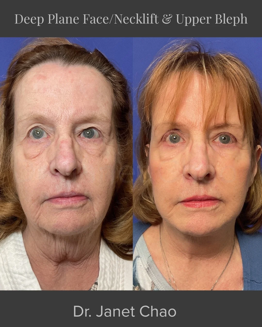 This was about honoring who she already is.

Her care began with an upper blepharoplasty to address excess eyelid skin that was affecting how she felt day to day. From there, over time and with thoughtful discussion, she chose to proceed with a deep 