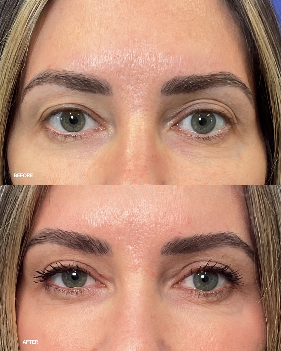This is what upper blepharoplasty healing actually looks like.

Before and after, followed by the full incision timeline over six months. Early swelling gives way to gradual refinement, with results that continue to improve well beyond the first few 