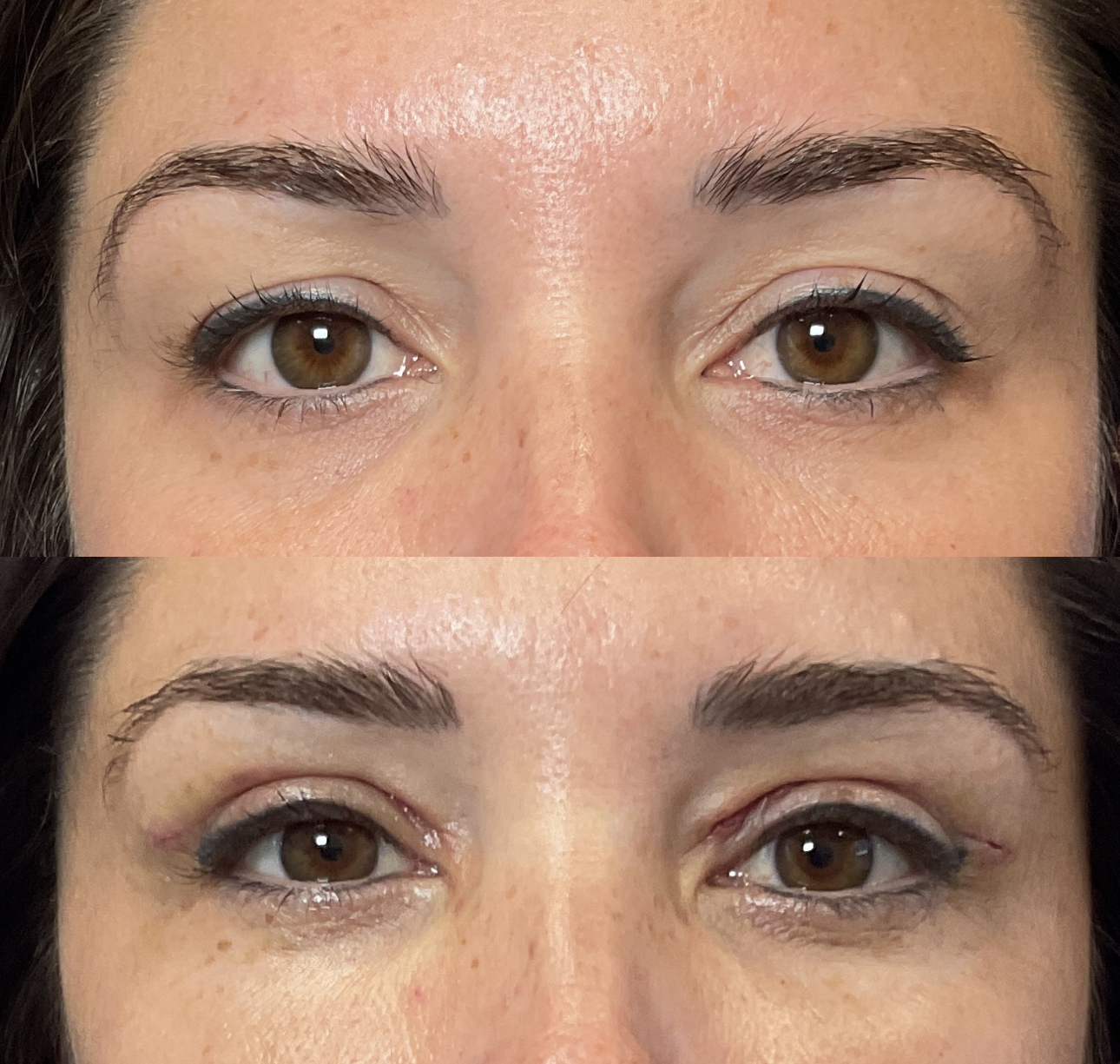 Patient healing and results 5 days after Upper Eyelid Surgery at Timeless Faces