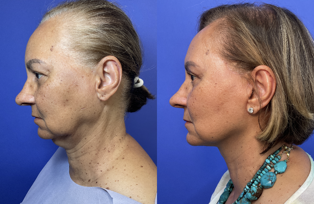 Before and After Photos after Lower Facelift and Upper Blepharoplasty