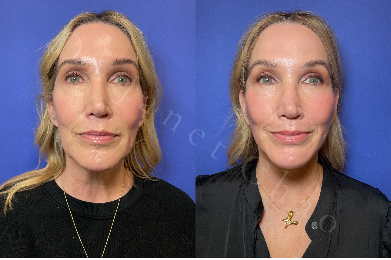 Revision Deep Plane Facelift Necklift before after 1 | Timeless Faces.png