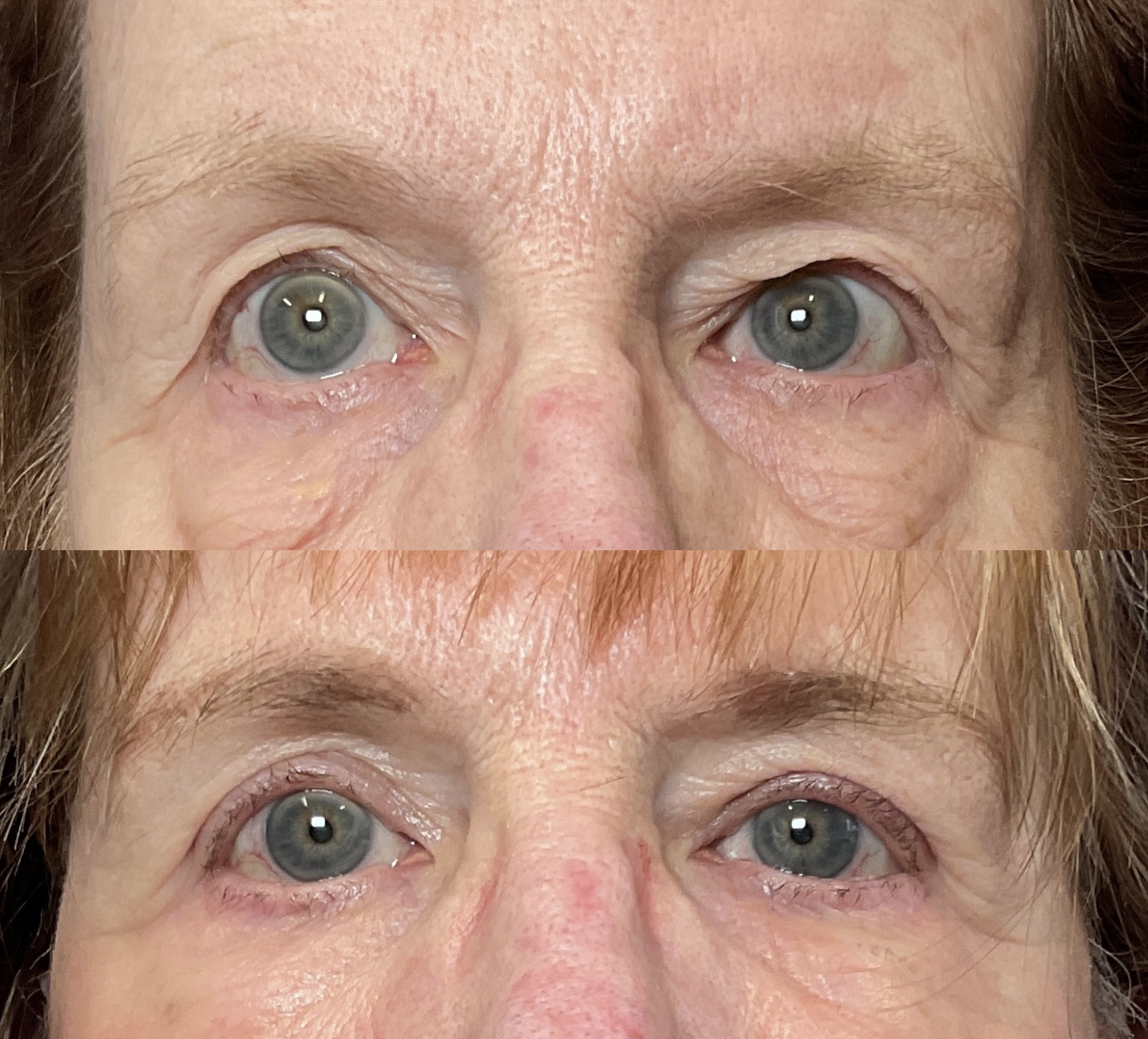 Before and After Photos after Upper Eyelid Surgery