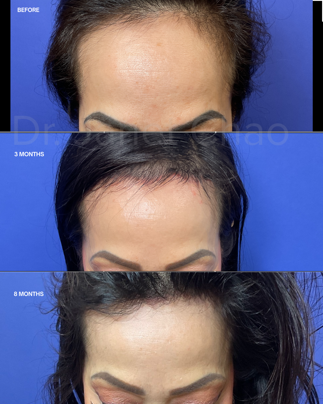 Recovery timeline spanning 8 months after hairline lowering surgery at Timeless Faces