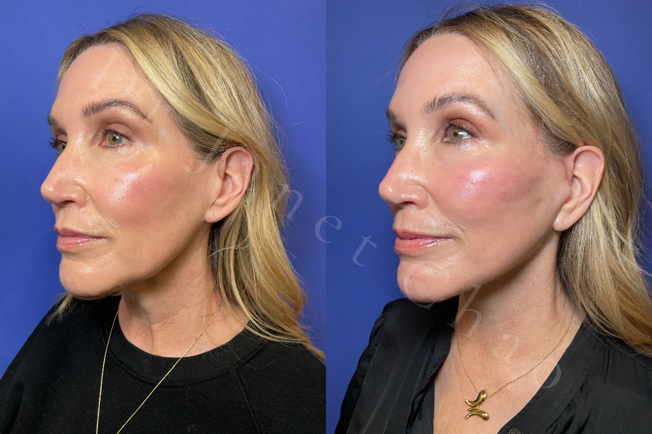 Revision Deep Plane Facelift Necklift before after 4 | Timeless Faces.png