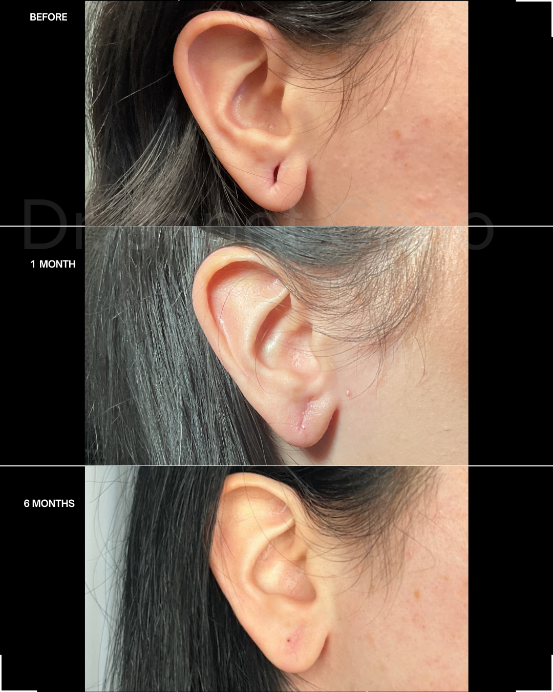 A recovery timeline spanning 6 months following earlobe repair at Timeless Faces