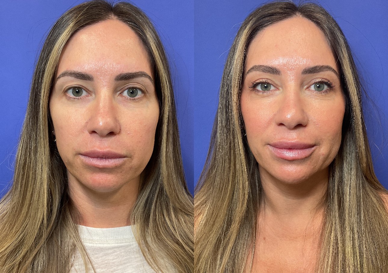 Upper Blepharoplasty in a 40 year old