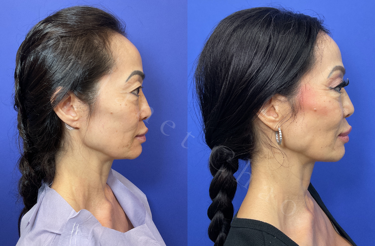 Hairline Lowering/Forehead Reduction
