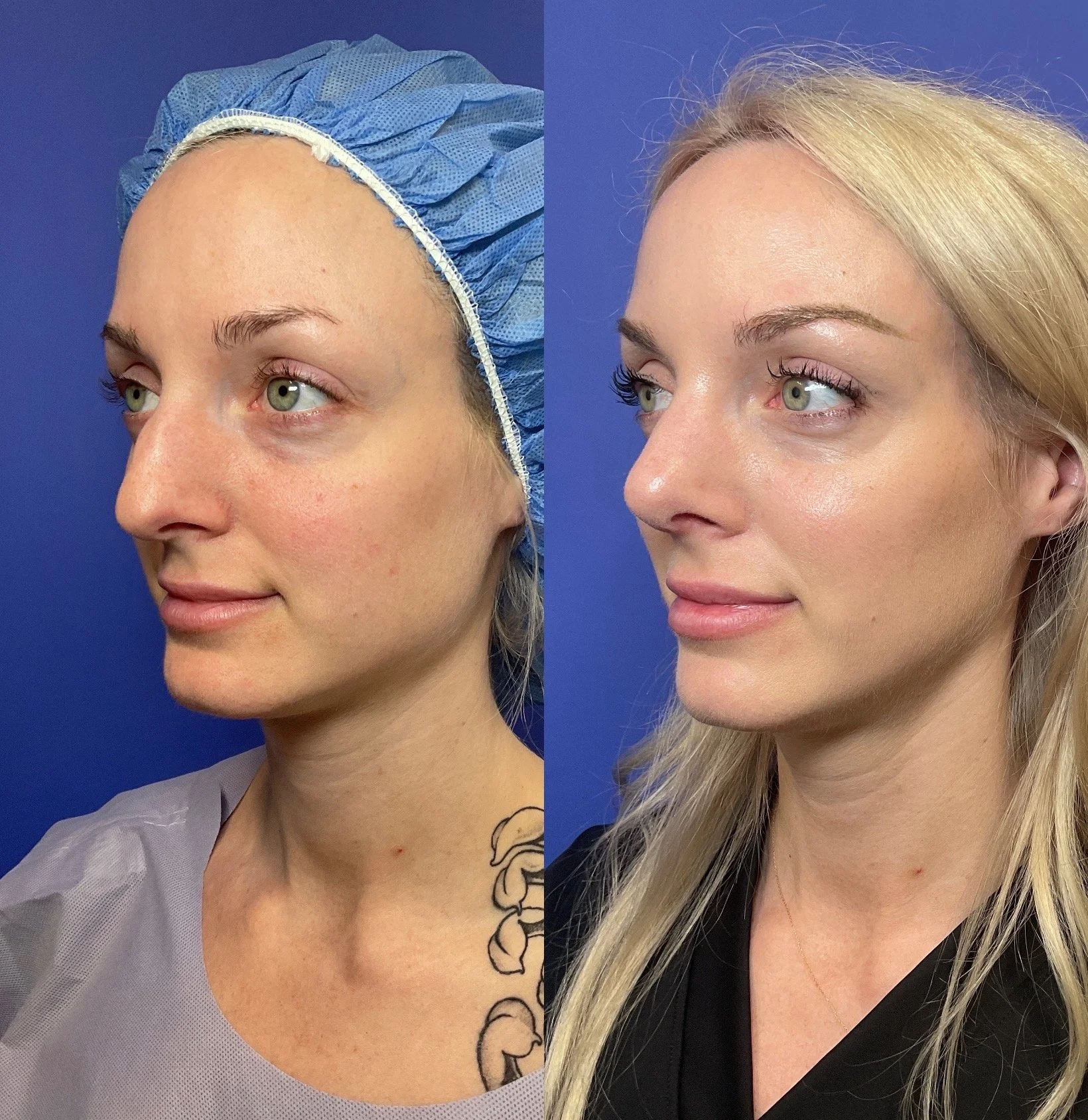 Rhinoplasty Before and After Photo