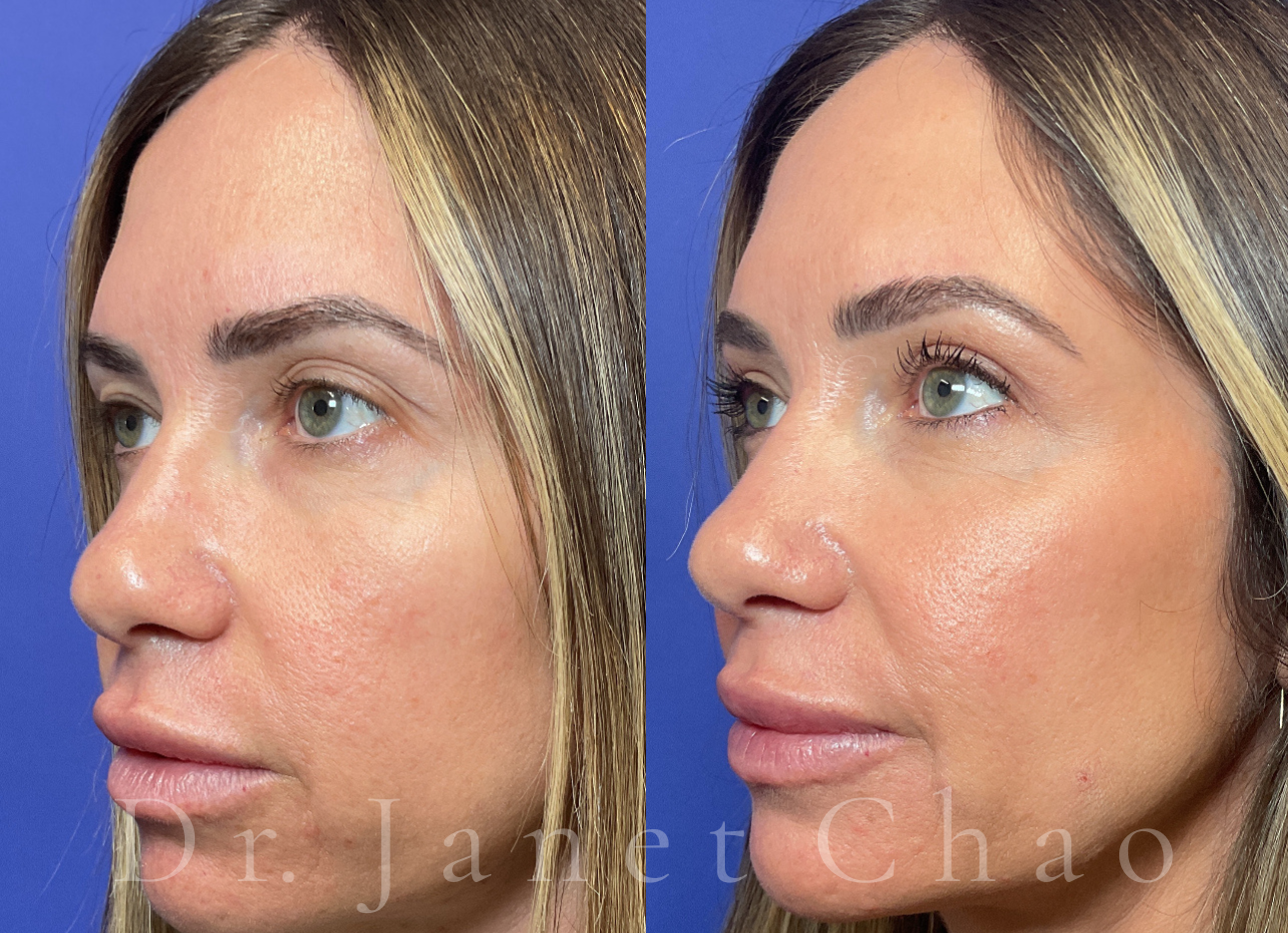 Upper Eyelid Surgery Blepharoplasty before after 4 | Timeless Faces.png