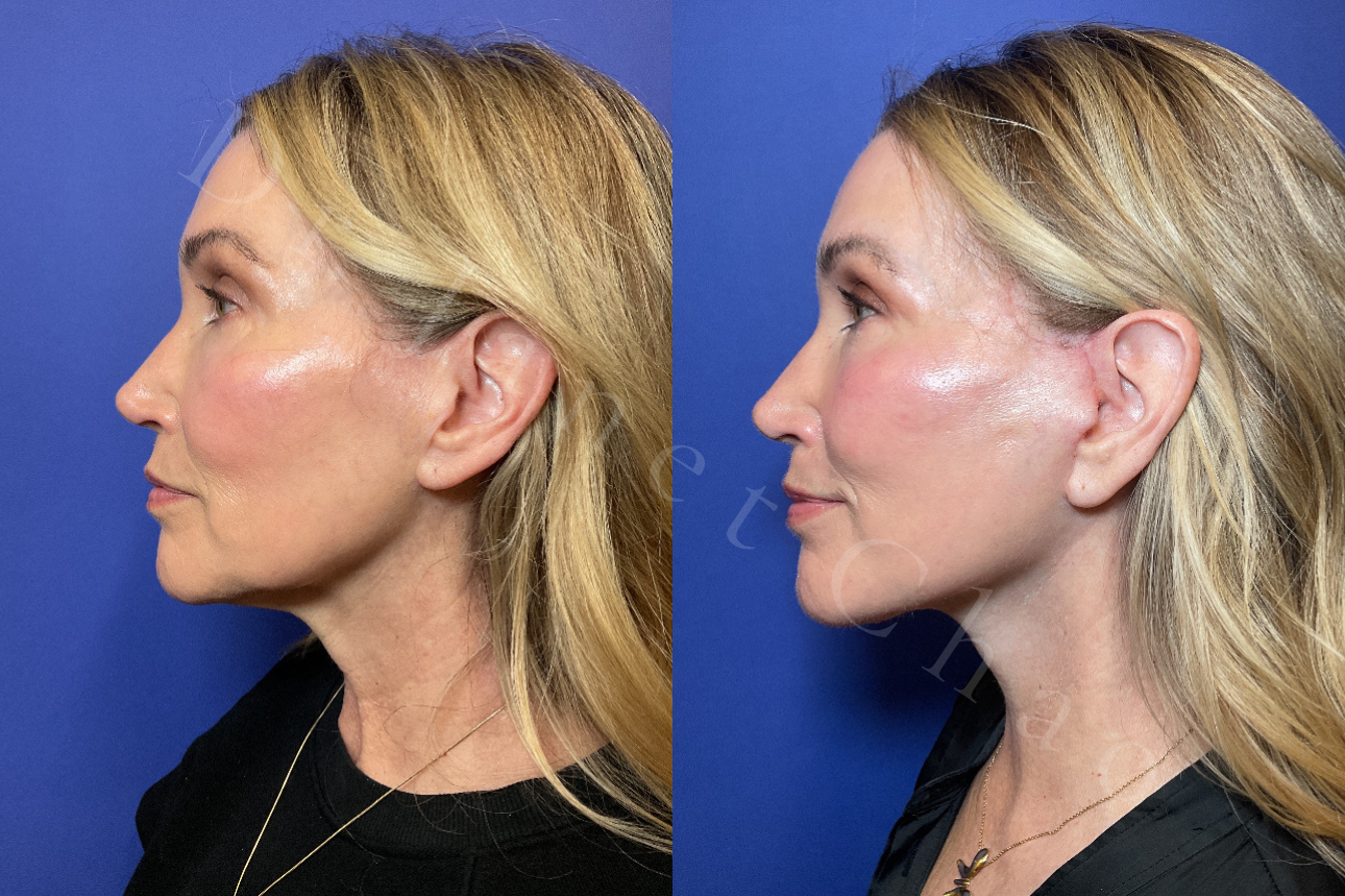 Revision Deep Plane Facelift Necklift before after 7 | Timeless Faces.png