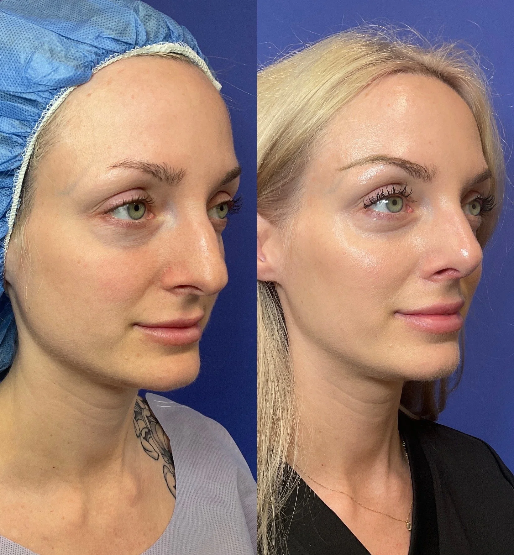 Rhinoplasty Before and After Photo