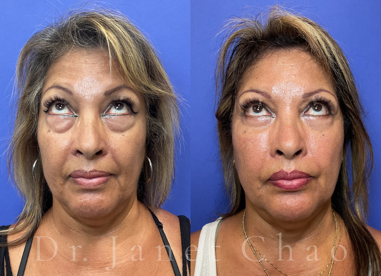 Upper and lower blepharoplasty before after 5 | Timeless Faces.png