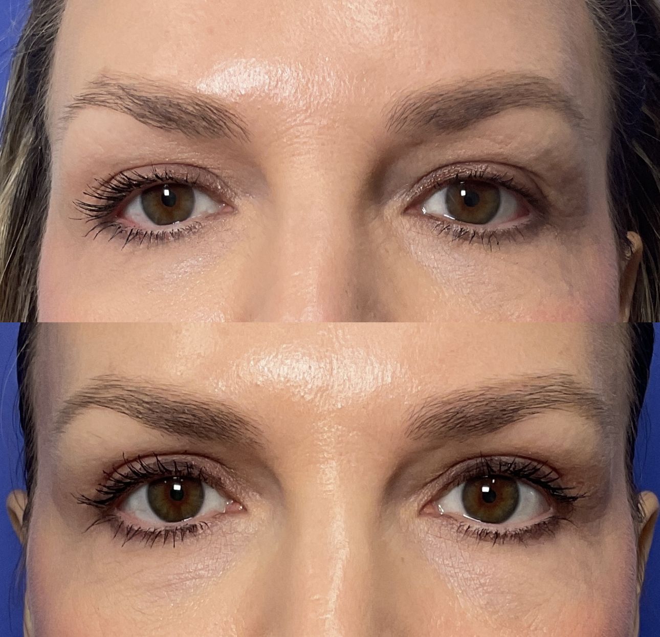 Patient results 3 months after Upper Eyelid Surgery at Timeless Faces