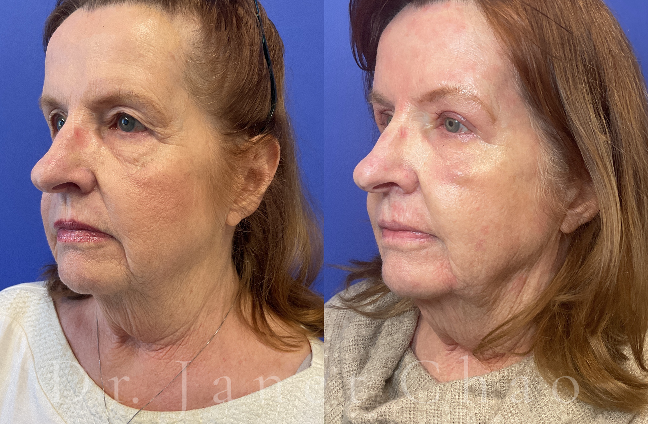 Eyelid Surgery Upper Blepharoplasty before after 6 | Timeless Faces.png