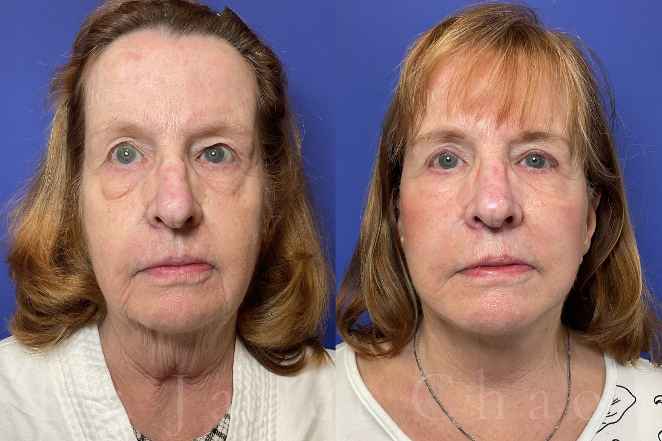 Deep Plane Facelift 70 year old