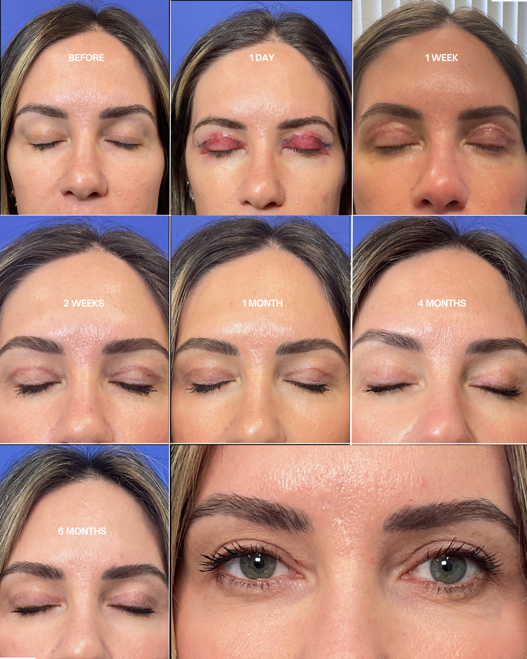 Timeline of upper eyelid incisions healing over the course of 6 months